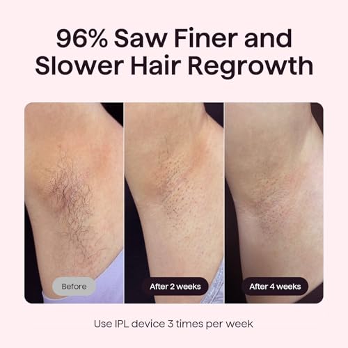 Wavytalk IPL Hair Removal Device with Ice Cooling