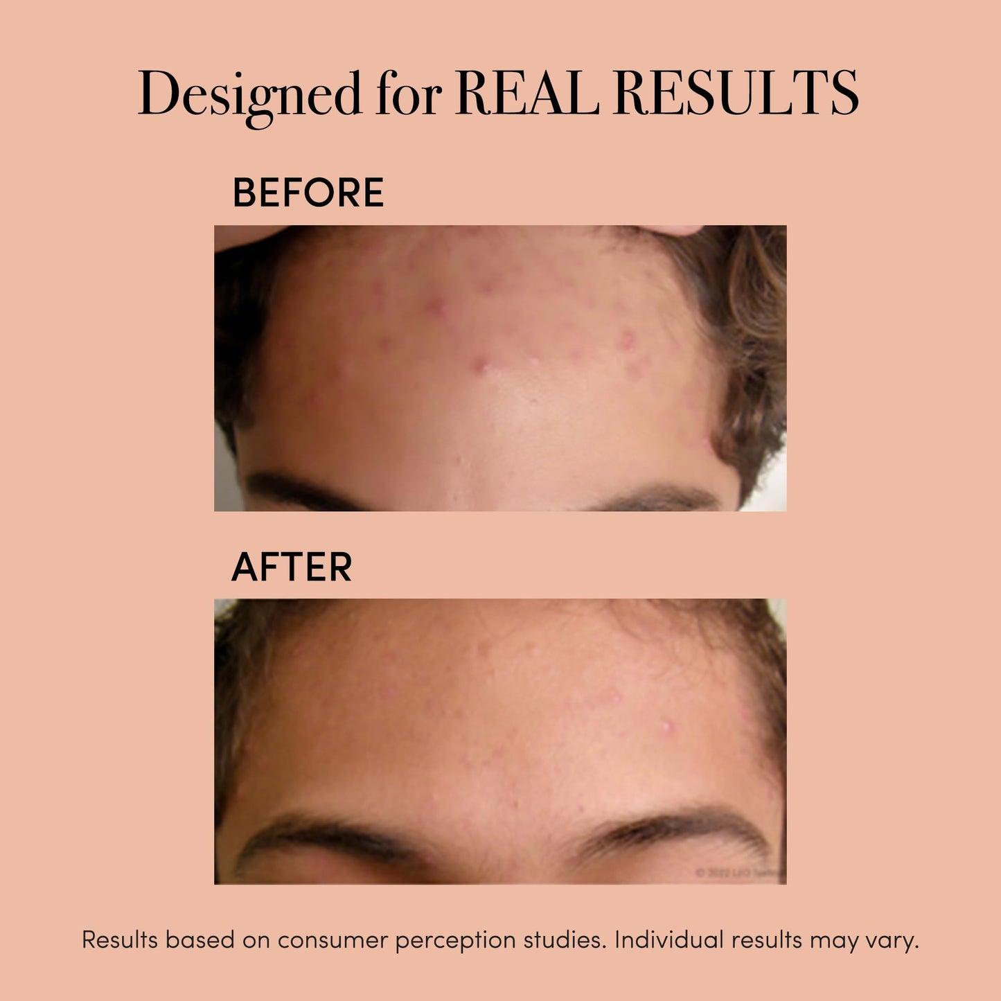 reVive Light Therapy Acne and Anti-aging Treatment for Face, Blue Light Therapy Device