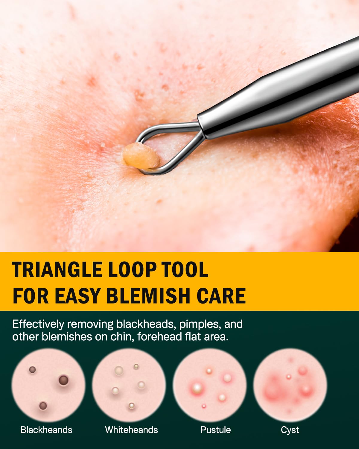 FVION Professional Acne Removal Tool Set