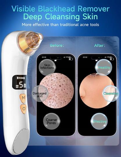 Blackhead Remover Pore Vacuum with Camera & Heating