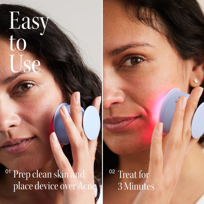 Solawave Bye Acne Light Therapy Wand for Face & Body